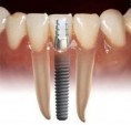 /album/dental-implant/implant-1-jpg/